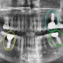 성남 치과 수면 임플란트 로 치아 충치와 잇몸치료로 해결 안 되는 녹은 골 부위 어금니 식립 수술 진행