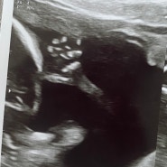 임신15주~16주 혈압 성별 확인 딸낳는법 시도 과연 딸일까요?