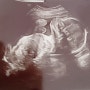 [임신 22-23주차] 증상 및 정밀 초음파 결과, 강서 미즈메디 입체초음파 비용