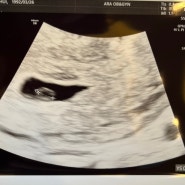 [임신 5주+6일] 갈색혈, 선홍빛 피비침, 아기집모양이상
