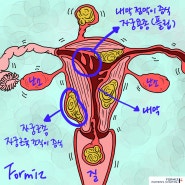 자궁 물혹 증상 원인별 수술 치료 방법