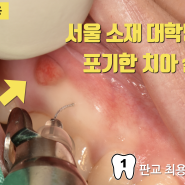 [오늘 살린 치아] 대학 병원 안간다는 환자의 치아 살리기 #치아살리기 #판교최용훈치과 #플라젠신경치료