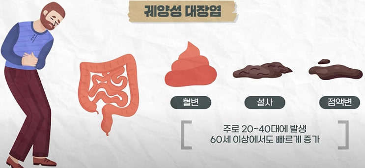 “염증성 장질환, 천공·농양·대장암 유발, 예방 중요” ... 서울대병원 고성준 교수 : 네이버 블로그