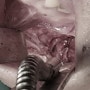 성형외과 사망사고 - 안면윤곽 수술 부작용 출혈- 실제 혈관 사진 동영상