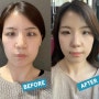 [리뷰] 명동 피부과 얼굴 리프팅 에어젯 솔직후기 에어젯 비포애프터 효과 / 가격 / 주의사항 리프팅 강추임