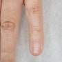 양재 새끼손톱 들림 조갑박리 손톱 끝이 하얗게 케어하는 방법은?