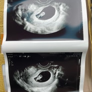 임신 6주~8주 초음파, 입덧 시작