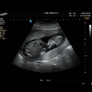 [임신5] 산부인과 정기검진 4 :: 초음파, 2차 갑상선 검사