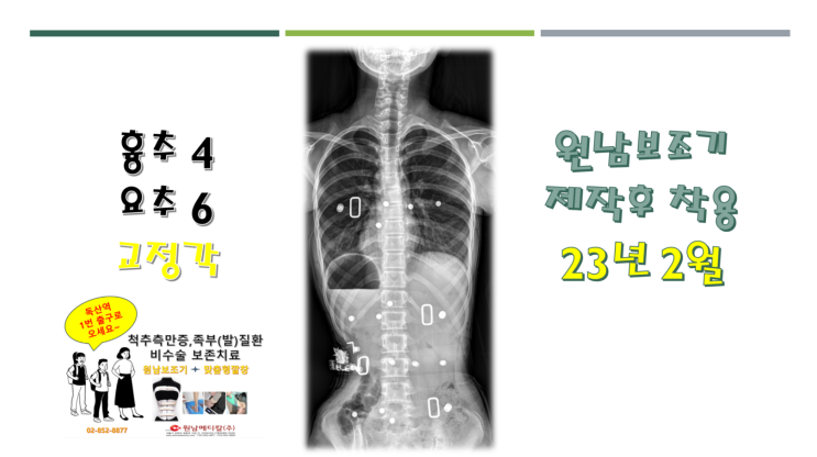 척추측만교정기 착용1년후. 요추와 흉추 모두 개선되며 측만을 방어중인 사례- 원남보조기 : 네이버 블로그