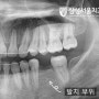 무실동 치과 - 교정 끝난 환자의 비어있는 아래턱 어금니 치아 임플란트 수술 후기