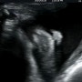 [임신34주]수지미래산부인과의원 34주 초음파 후기