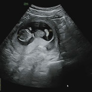 임신 12주, 1차 기형아검사, NIPT 검사, 12주 아기크기, 병원에서 기절하다.. 임산부 빈혈