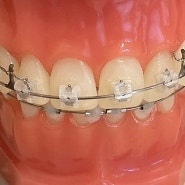 덧니 교정(치아총생) 라미네이트 치료 or 치아교정 장단점