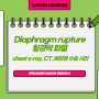 Diaphragm rupture, 횡경막 파열 chest x-ray, CT 그리고 복강경 수술 사진
