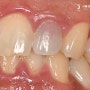용산치과 치수괴사에 의해 변색된 치아, 신경치료 후 크라운 과정