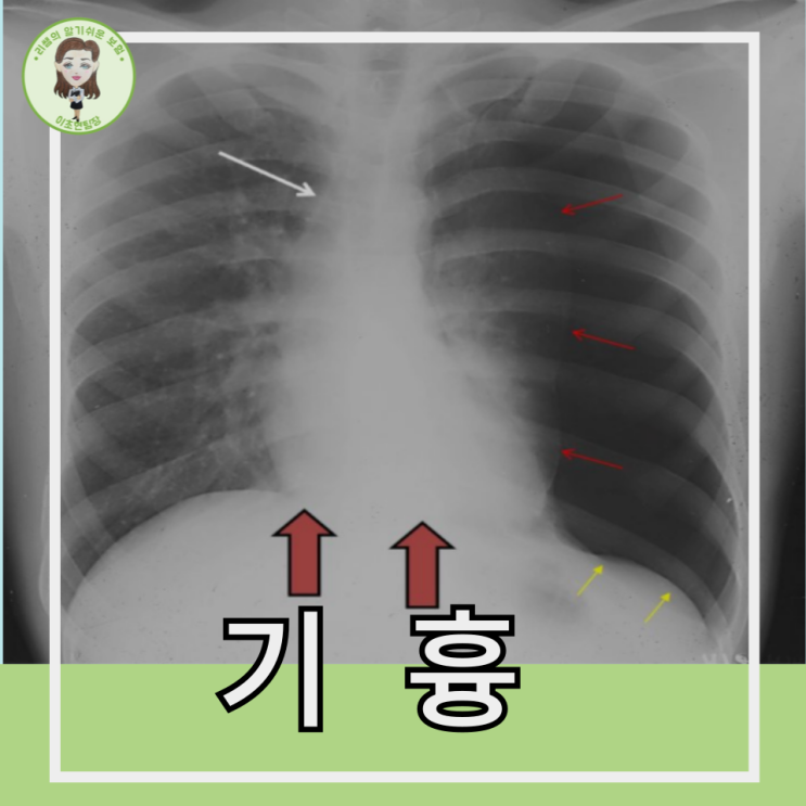 기흉의 원인과 초기 증상 치료방법에 대해 : 네이버 블로그