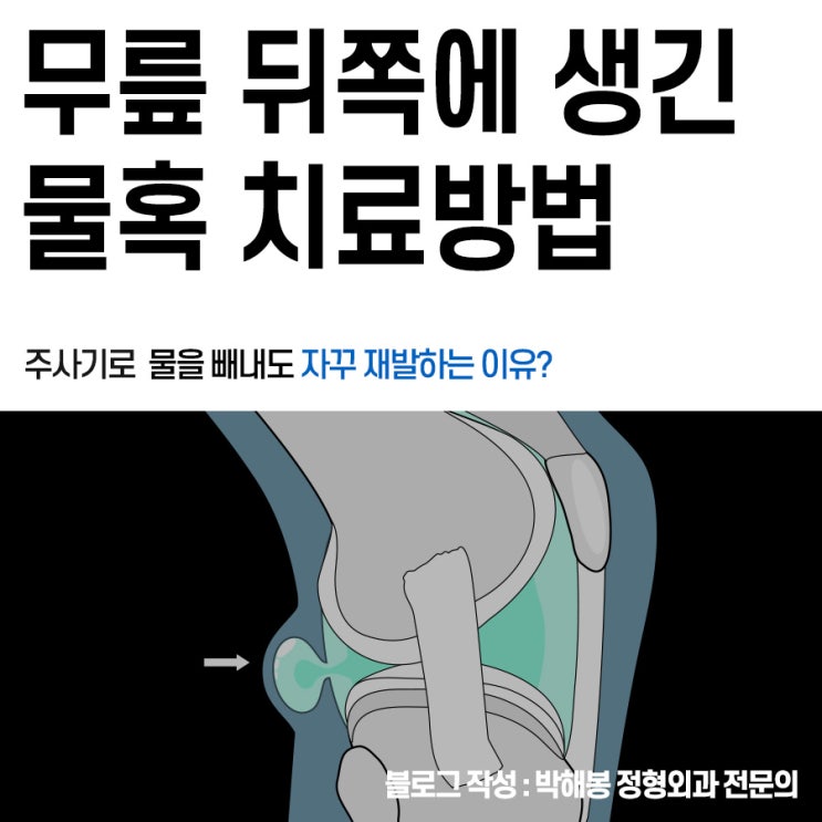 오금뜻, 통증 원인 베이커낭종 (물혹 주사치료) : 네이버 블로그