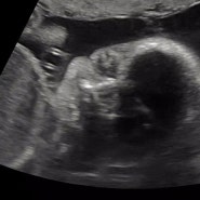 임신 21주~25주 초음파, 임당검사 및 증상 : 최상의 상태
