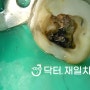 재신경치료 하는 이유 및 치과 신경치료 중 후 술과 담배 가능한가요 ? 음주 흡연과의 연관성