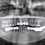 상인동 치과 오래된 브릿지는 문제를 일으키게 되어 임플란트 식립을 필요로 하게 될 수 있습니다.
