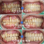 임플란트 재식립 포함 위아래 치아 다수 수술과정 공개(강남역 치과)