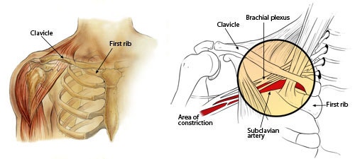 흉곽출구증후군 검사(가슴문증후군,Thoracic Outlet Sydnrome)-Roos test,Adson test ...