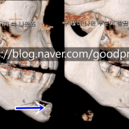 무턱 수술 방법 중 이설근전진술 후 과도한 턱끝 교정위한 턱끝축소술 후기