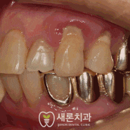 포항 치과 - 난이도 높은 '상악동 거상술' 뼈이식 임플란트?