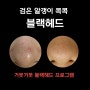 차앤박피부과 양재 신경쓰이는 블랙헤드 관리하기