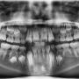 [소아치과] 영구치의 한번 결정된 맹출 방향은 바뀌지 않는다! (Eruption path of permanent tooth)