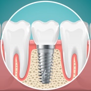 위례 임플란트 종류 치아 상태에 따른 안전한 진료