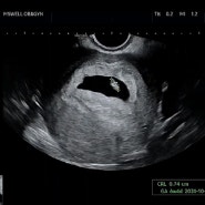 [임신~8주] 임신초기증상, 아기집 난황 확인, 임산부 등록