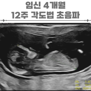 임신4개월 임신12주 각도법 초음파
