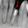 뿌리만 남은 앞니 성남 치과 에서 발치 즉시 임플란트 식립 (디지털 네비게이션 방식)