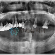 연세뉴치과의 다수 치아 발치 즉시 임플란트를 소개해드립니다 / 천안 임플란트 치과 / 아산 임플란트 치과 / 천안아산역 임플란트 치과