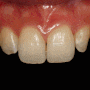 귀안동 치과 투명교정 및 무삭제 라미네이트를 통한 심미성 개선 과정