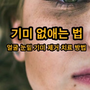 기미 없애는 법 얼굴 눈밑 제거 근본적인 치료 필요한 이유