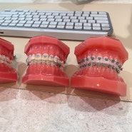 치아재교정함