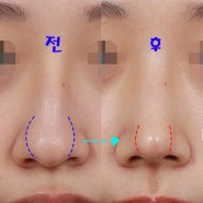 복코교정 수술방법과 사례 찐후기(신사역성형외과 치유)