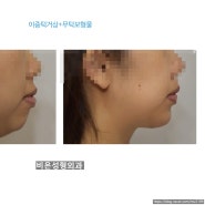 [강남 비온 성형외과] 무턱 콤플렉스 해결법은? 턱끝성형 or 무턱보형물수술.
