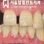 청주 치과 추천 - 충치 염증 가득한 앞니 발치 후 임플란트 식립 및 임시 치아 즉시 로딩 후기