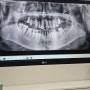 [치과치료]⑦ 임플란트 나사 식립/윗잇몸 양끝