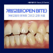 알아두면 쓸모있는 치과정보 EP 102. 개방교합(Open Bite, 오픈 바이트) 교정 치료 사례