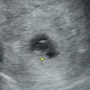 👶[임신 0주-6주] 임신 확인 및 아기집, 난황, 심장소리(+임신확인서 발급)