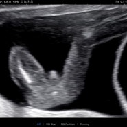 [임신기록] 13주차 16주차 쌍둥이 초음파 2차 기형아검사ㅣ 태반 내려옴 출혈 쌍둥이 성별(동탄제일병원)