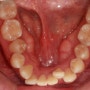 성인교정 잠실 인비절라인 삐뚤어진 치아 교정하기, 발치없이 빠른교정