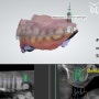 잇몸 질환으로 뽑은 치아, "성남 치과 에서 디지털 임플란트 하려고 기다렸어요."