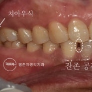 범계역 치과 에서 충치와 앞니 벌어짐을 해결한 50대 여성분