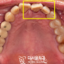 넘어져서 생긴 앞니 흔들림, 성남 치과 에서 전치 아탈구 치료한 증례
