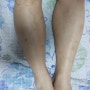 무릎의 감각이 없을때의 치료사례